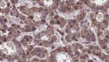 SSTR5 Antibody - 1:100 staining human liver carcinoma tissues by IHC-P. The sample was formaldehyde fixed and a heat mediated antigen retrieval step in citrate buffer was performed. The sample was then blocked and incubated with the antibody for 1.5 hours at 22°C. An HRP conjugated goat anti-rabbit antibody was used as the secondary.