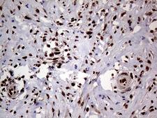SSU72 Antibody - Immunohistochemical staining of paraffin-embedded Human breast tissue within the normal limits using anti-SSU72 mouse monoclonal antibody. (Heat-induced epitope retrieval by 1mM EDTA in 10mM Tris buffer. (pH8.5) at 120°C for 3 min. (1:1000)