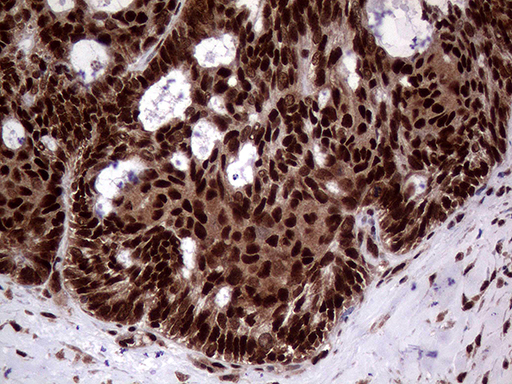 SSU72 Antibody - Immunohistochemical staining of paraffin-embedded Adenocarcinoma of Human ovary tissue using anti-SSU72 mouse monoclonal antibody. (Heat-induced epitope retrieval by 1mM EDTA in 10mM Tris buffer. (pH8.5) at 120°C for 3 min. (1:1000)
