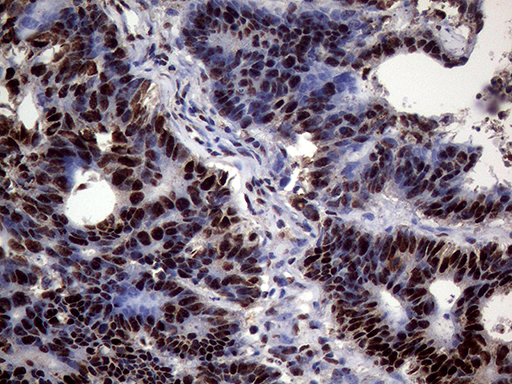 SSU72 Antibody - Immunohistochemical staining of paraffin-embedded Adenocarcinoma of Human colon tissue using anti-SSU72 mouse monoclonal antibody. (Heat-induced epitope retrieval by 1mM EDTA in 10mM Tris buffer. (pH8.5) at 120°C for 3 min. (1:1000)