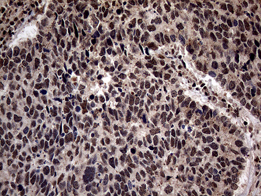 SSU72 Antibody - Immunohistochemical staining of paraffin-embedded Carcinoma of Human lung tissue using anti-SSU72 mouse monoclonal antibody. (Heat-induced epitope retrieval by 1mM EDTA in 10mM Tris buffer. (pH8.5) at 120°C for 3 min. (1:500)