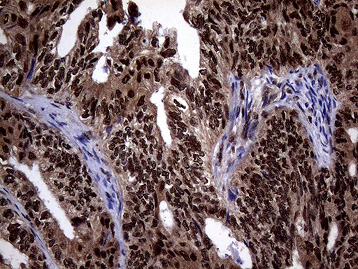 SSU72 Antibody - Immunohistochemical staining of paraffin-embedded Adenocarcinoma of Human ovary tissue using anti-SSU72 mouse monoclonal antibody. (Heat-induced epitope retrieval by 1mM EDTA in 10mM Tris buffer. (pH8.5) at 120°C for 3 min. (1:500)