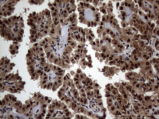 SSU72 Antibody - Immunohistochemical staining of paraffin-embedded Carcinoma of Human thyroid tissue using anti-SSU72 mouse monoclonal antibody. (Heat-induced epitope retrieval by 1mM EDTA in 10mM Tris buffer. (pH8.5) at 120°C for 3 min. (1:500)
