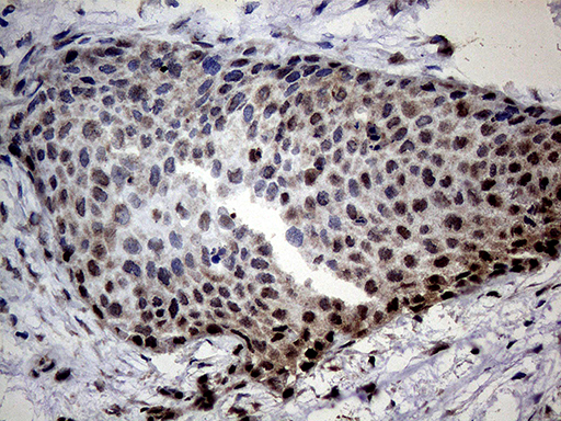 SSU72 Antibody - Immunohistochemical staining of paraffin-embedded Carcinoma of Human bladder tissue using anti-SSU72 mouse monoclonal antibody. (Heat-induced epitope retrieval by 1mM EDTA in 10mM Tris buffer. (pH8.5) at 120°C for 3 min. (1:500)