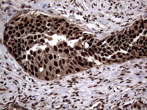 SSU72 Antibody - Immunohistochemical staining of paraffin-embedded Carcinoma of Human kidney tissue using anti-SSU72 mouse monoclonal antibody. (Heat-induced epitope retrieval by 1mM EDTA in 10mM Tris buffer. (pH8.5) at 120°C for 3 min. (1:500)