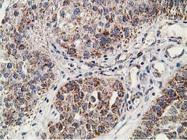 SSX1 Antibody - IHC of paraffin-embedded Carcinoma of Human bladder tissue using anti-SSX1 mouse monoclonal antibody.