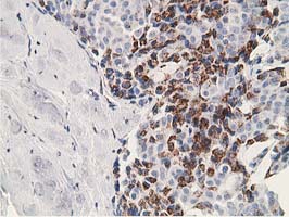SSX1 Antibody - IHC of paraffin-embedded Adenocarcinoma of Human breast tissue using anti-SSX1 mouse monoclonal antibody. (Heat-induced epitope retrieval by 10mM citric buffer, pH6.0, 100C for 10min).