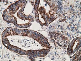 SSX1 Antibody - IHC of paraffin-embedded Adenocarcinoma of Human colon tissue using anti-SSX1 mouse monoclonal antibody. (Heat-induced epitope retrieval by 10mM citric buffer, pH6.0, 100C for 10min).