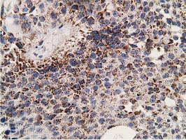 SSX1 Antibody - IHC of paraffin-embedded Carcinoma of Human bladder tissue using anti-SSX1 mouse monoclonal antibody. (Heat-induced epitope retrieval by 10mM citric buffer, pH6.0, 100C for 10min).