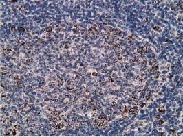 SSX1 Antibody - IHC of paraffin-embedded Human lymph node tissue using anti-SSX1 mouse monoclonal antibody. (Heat-induced epitope retrieval by 10mM citric buffer, pH6.0, 100C for 10min).