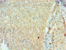 SSX2 Antibody - Immunohistochemistry of paraffin-embedded human cervical cancer using antibody at 1:100 dilution.