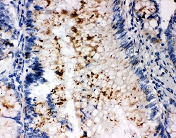 SSX2 Antibody - IHC-P: SSX2 antibody testing of human intestinal cancer tissue
