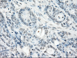 SSX2 Antibody - IHC of paraffin-embedded Adenocarcinoma of colon tissue using anti-SSX2 mouse monoclonal antibody. (Dilution 1:50).