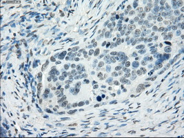 SSX2 Antibody - IHC of paraffin-embedded Adenocarcinoma of ovary tissue using anti-SSX2 mouse monoclonal antibody. (Dilution 1:50).
