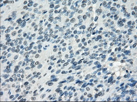 SSX2 Antibody - IHC of paraffin-embedded Carcinoma of bladder tissue using anti-SSX2 mouse monoclonal antibody. (Dilution 1:50).