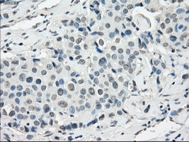 SSX2 Antibody - IHC of paraffin-embedded Adenocarcinoma of breast tissue using anti-SSX2 mouse monoclonal antibody. (Dilution 1:50).