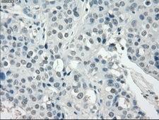 SSX2 Antibody - IHC of paraffin-embedded Adenocarcinoma of breast tissue using anti-SSX2 mouse monoclonal antibody. (Dilution 1:50).