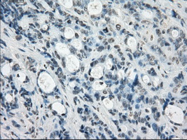 SSX2 Antibody - IHC of paraffin-embedded Adenocarcinoma of colon tissue using anti-SSX2 mouse monoclonal antibody. (Dilution 1:50).