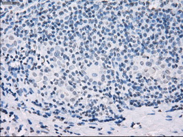 SSX2 Antibody - IHC of paraffin-embedded Carcinoma of thyroid tissue using anti-SSX2 mouse monoclonal antibody. (Dilution 1:50).