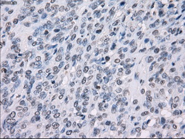SSX2 Antibody - IHC of paraffin-embedded Carcinoma of bladder tissue using anti-SSX2 mouse monoclonal antibody. (Dilution 1:50).