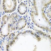 SSX2 Antibody - Immunohistochemistry of paraffin-embedded Human colon carcinoma using SSX2 Polyclonal Antibody at dilution of 1:200 (40x lens).