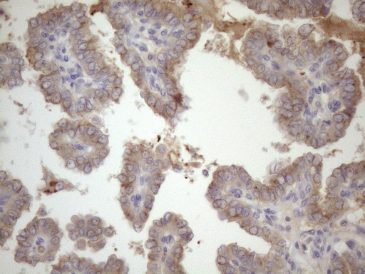 SSX2IP Antibody - Immunohistochemical staining of paraffin-embedded Carcinoma of Human thyroid tissue using anti-SSX2IP mouse monoclonal antibody. (Heat-induced epitope retrieval by 1mM EDTA in 10mM Tris buffer. (pH8.5) at 120 oC for 3 min. (1:150)