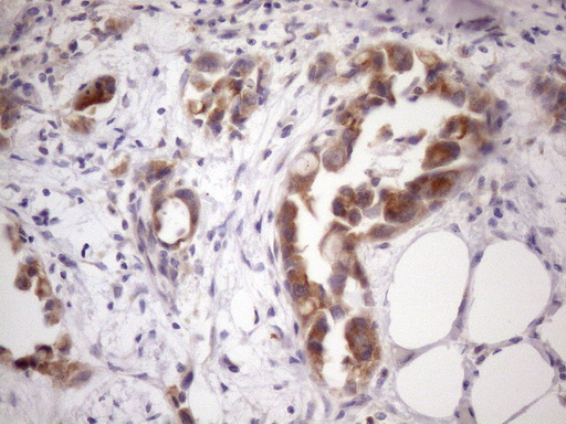 SSX2IP Antibody - Immunohistochemical staining of paraffin-embedded Adenocarcinoma of Human endometrium tissue using anti-SSX2IP mouse monoclonal antibody. (Heat-induced epitope retrieval by 1mM EDTA in 10mM Tris buffer. (pH8.5) at 120 oC for 3 min. (1:150)