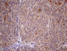 SSX2IP Antibody - Immunohistochemical staining of paraffin-embedded Human thyroid tissue within the normal limits using anti-SSX2IP mouse monoclonal antibody. (Heat-induced epitope retrieval by 1mM EDTA in 10mM Tris buffer. (pH8.5) at 120 oC for 3 min. (1:150)