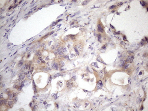 SSX2IP Antibody - Immunohistochemical staining of paraffin-embedded Adenocarcinoma of Human colon tissue using anti-SSX2IP mouse monoclonal antibody. (Heat-induced epitope retrieval by 1mM EDTA in 10mM Tris buffer. (pH8.5) at 120 oC for 3 min. (1:150)