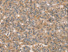 SSX2IP Antibody - Immunohistochemistry of paraffin-embedded Human liver cancer using SSX2IP Polyclonal Antibody at dilution of 1:45.