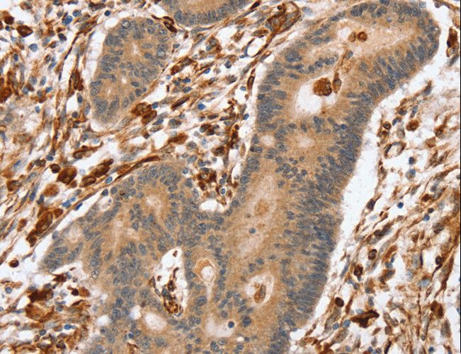 SSX2IP Antibody - Immunohistochemistry of paraffin-embedded Human colon cancer using SSX2IP Polyclonal Antibody at dilution of 1:45.