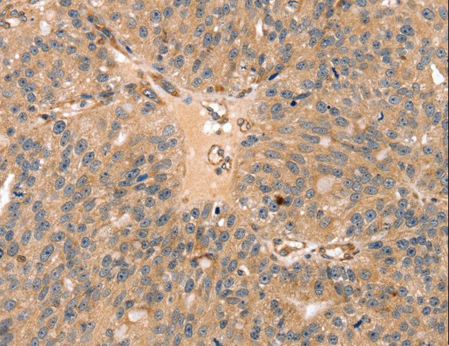 SSX2IP Antibody - Immunohistochemistry of paraffin-embedded Human breast cancer using SSX2IP Polyclonal Antibody at dilution of 1:35.