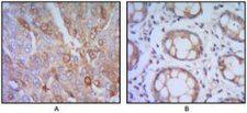 ST13 Antibody - IHC of paraffin- embedded human lung cancer (A), colon cancer (B) using ST13 mouse mAb with DAB staining.