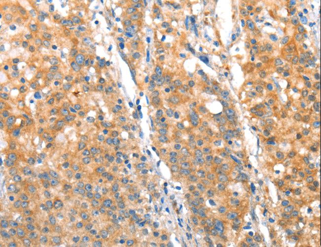ST14 / Matriptase Antibody - Immunohistochemistry of paraffin-embedded Human thyroid cancer using ST14 Polyclonal Antibody at dilution of 1:70.