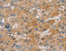 ST18 Antibody - Immunohistochemistry of paraffin-embedded Human liver cancer using ST18 Polyclonal Antibody at dilution of 1:50.
