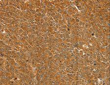 ST18 Antibody - Immunohistochemistry of paraffin-embedded Human ovarian cancer using ST18 Polyclonal Antibody at dilution of 1:50.