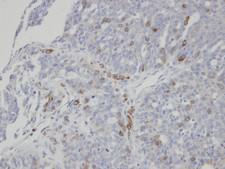 ST3GAL1 Antibody - IHC of paraffin-embedded serous OVCA using ST3GAL1 antibody at 1:100 dilution.