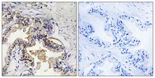 ST6GAL1 / CD75 Antibody - Peptide - + Immunohistochemistry analysis of paraffin-embedded human prostate carcinoma tissue, using ST6GAL1 antibody.