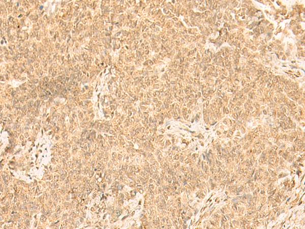 ST8SIA4 Antibody - Immunohistochemistry of paraffin-embedded Human ovarian cancer tissue  using ST8SIA4 Polyclonal Antibody at dilution of 1:50(×200)