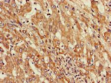 ST8SIA5 Antibody - Immunohistochemistry of paraffin-embedded human liver cancer using ST8SIA5 Antibody at dilution of 1:100