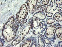 STAF50 / TRIM22 Antibody - IHC of paraffin-embedded Carcinoma of Human thyroid tissue using anti-TRIM22 mouse monoclonal antibody. (Heat-induced epitope retrieval by 10mM citric buffer, pH6.0, 120°C for 3min).