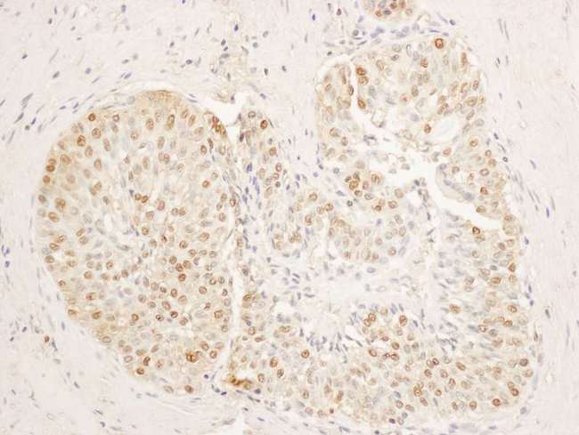 STAG1 / SA1 Antibody - Detection of Human SA1 by Immunohistochemistry. Sample: FFPE section of human prostate carcinoma. Antibody: Affinity purified rabbit anti-SA1 used at a dilution of 1:5000 (0.2 ug/ml). Detection: DAB.