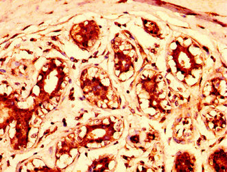 STAG3 Antibody - Immunohistochemistry image at a dilution of 1:300 and staining in paraffin-embedded human breast cancer performed on a Leica BondTM system. After dewaxing and hydration, antigen retrieval was mediated by high pressure in a citrate buffer (pH 6.0) . Section was blocked with 10% normal goat serum 30min at RT. Then primary antibody (1% BSA) was incubated at 4 °C overnight. The primary is detected by a biotinylated secondary antibody and visualized using an HRP conjugated SP system.