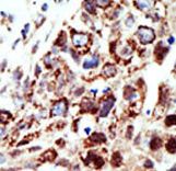 STAM1 / STAM Antibody - Formalin-fixed and paraffin-embedded human cancer tissue reacted with the primary antibody, which was peroxidase-conjugated to the secondary antibody, followed by AEC staining. This data demonstrates the use of this antibody for immunohistochemistry; clinical relevance has not been evaluated. BC = breast carcinoma; HC = hepatocarcinoma.