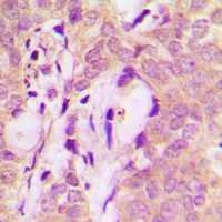 STAM2 Antibody - Immunohistochemical analysis of STAM2 staining in human breast cancer formalin fixed paraffin embedded tissue section. The section was pre-treated using heat mediated antigen retrieval with sodium citrate buffer (pH 6.0). The section was then incubated with the antibody at room temperature and detected using an HRP conjugated compact polymer system. DAB was used as the chromogen. The section was then counterstained with hematoxylin and mounted with DPX.