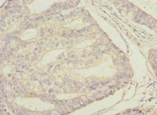 STAM2 Antibody - Immunohistochemistry of paraffin-embedded human endometrial cancer at dilution 1:100