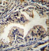 STAMBP / AMSH Antibody - STAMBP Antibody immunohistochemistry of formalin-fixed and paraffin-embedded human prostate carcinoma followed by peroxidase-conjugated secondary antibody and DAB staining.