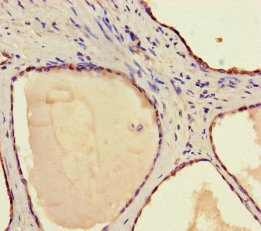 STAMBP / AMSH Antibody - Immunohistochemistry of paraffin-embedded human prostate cancer using STAMBP Antibody at dilution of 1:100