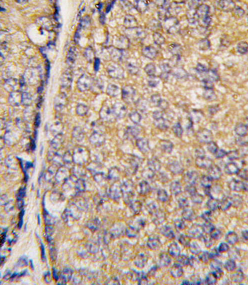 STAP1 / BRDG1 Antibody - Formalin-fixed and paraffin-embedded human prostate carcinoma tissue reacted with STAP1 antibody (F56) , which was peroxidase-conjugated to the secondary antibody, followed by DAB staining. This data demonstrates the use of this antibody for immunohistochemistry; clinical relevance has not been evaluated.