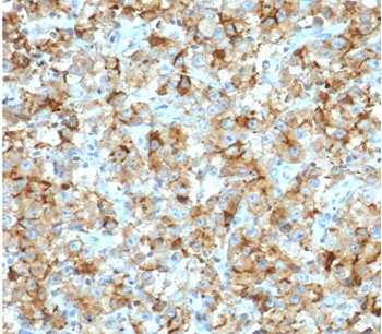 STAR Antibody - IHC staining of FFPE human testicular carcinoma with StAR antibody (clone SARP1-1). Required HIER: boil tissue sections in 10mM citrate buffer, pH 6, for 10-20 min followed by cooling at RT for 20 min.
